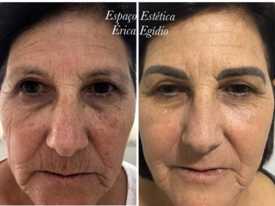 Resultado de rejuvenescimento facial
